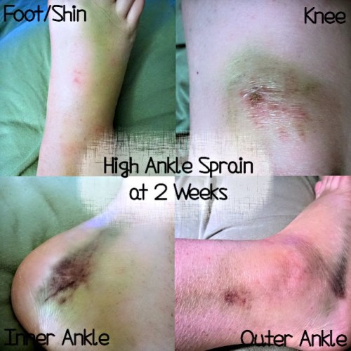 High Ankle Sprain at 2 Weeks