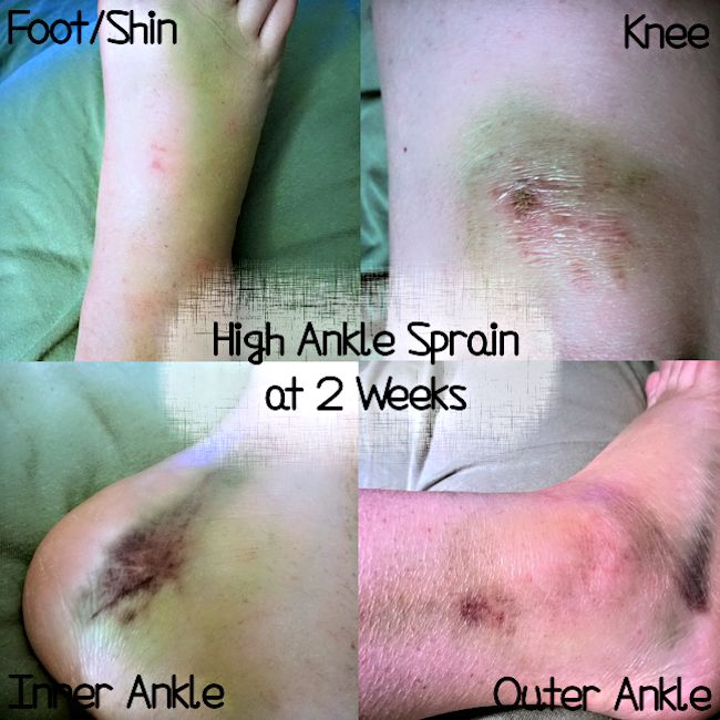 High Ankle Sprain at 2 Weeks